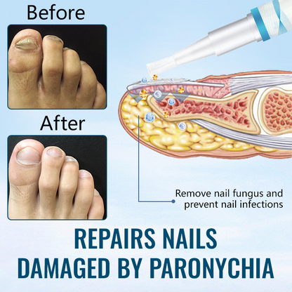 Ceoerty™ Anti-Paronychia Nail Repairing Gel