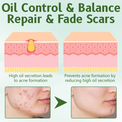 Ceoerty™ LeafNurture Acne Removal Cream