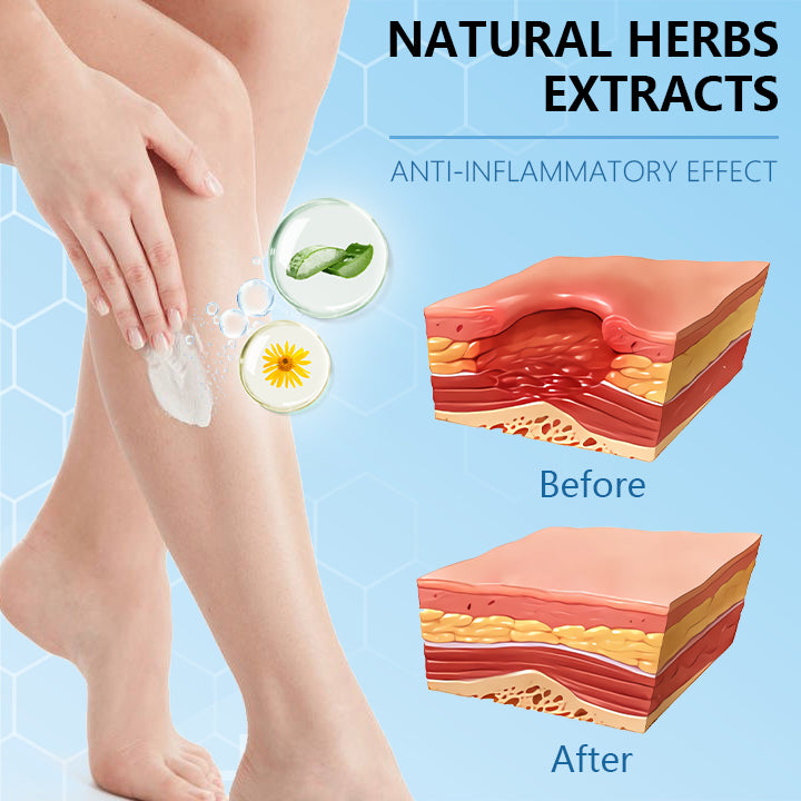 Ceoerty™ Varicose Veins Cream with Hydrogel